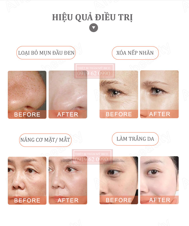 Hiệu quả điều trị cùng máy chăm sóc da đa chức năng Aqua Skin X