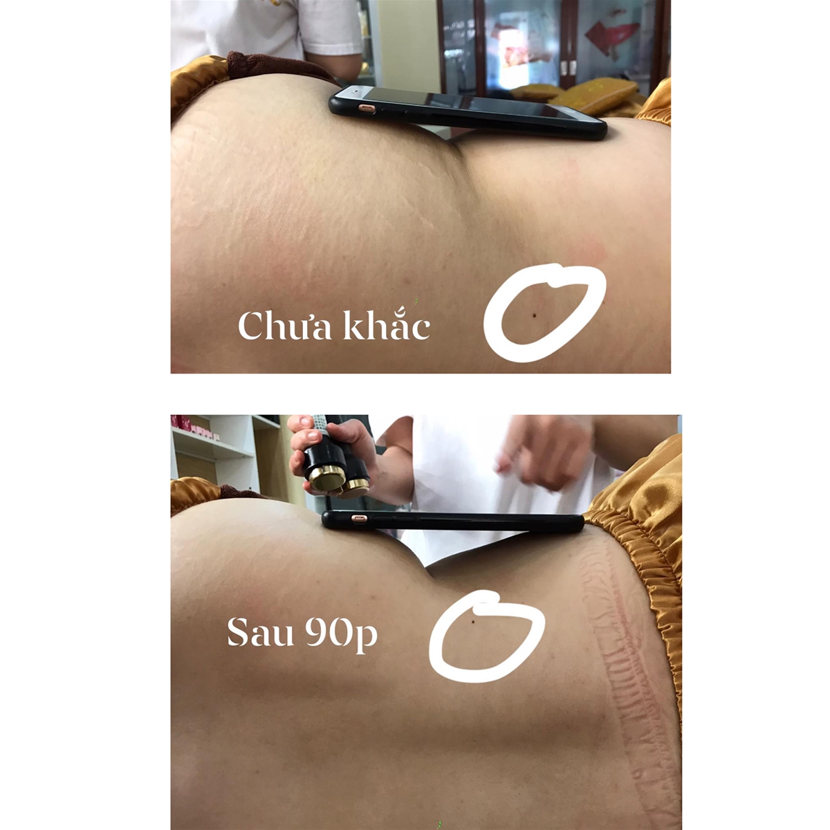 ảnh trước và sau khi dùng máy điêu khắc body chính hãng