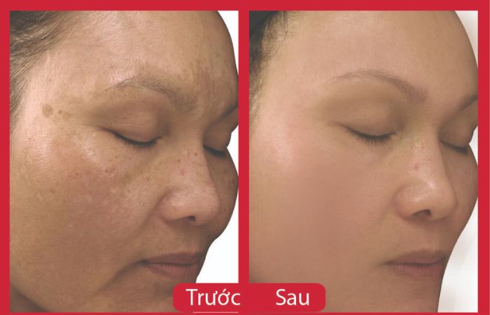 Công nghệ Laser Toning có hiệu quả trị nám vượt trội