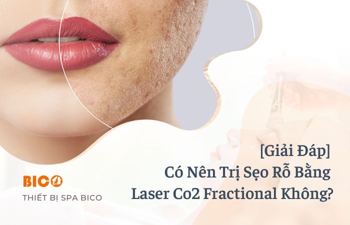 [Giải Đáp] Có Nên Trị Sẹo Rỗ Bằng Laser Co2 Fractional Không?