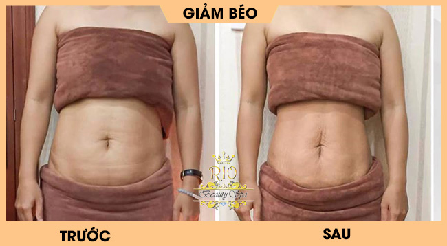 giảm béo bằng máy điêu khắc body