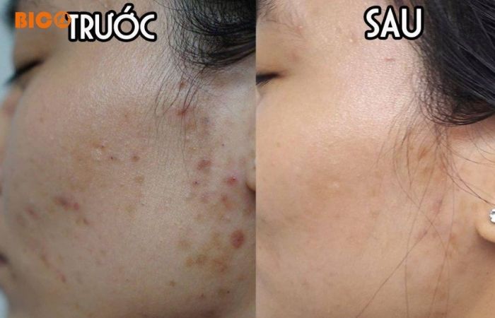 Lý do nên sử dụng tế bào gốc trị mụn Bicos