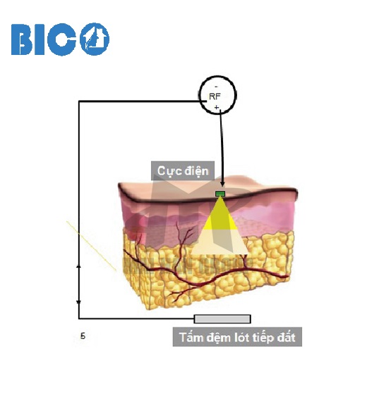 Máy Giảm Béo RF Đơn Cực - BARON