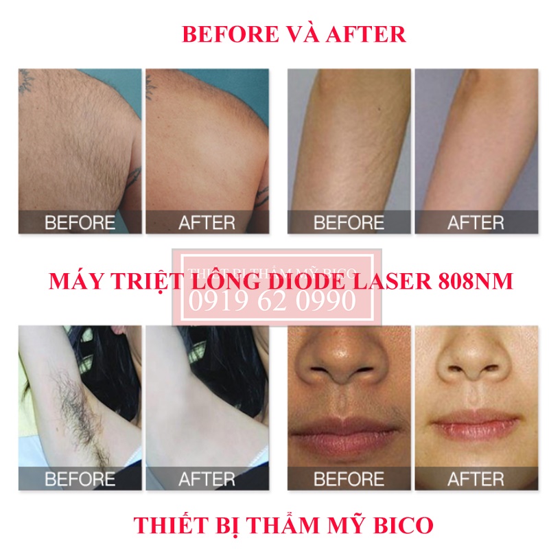 Máy Triệt Lông Diode Laser 808nm - Máy Triệt Lông Laser 1 Tay Cầm Chính Hãng - Máy Triệt Lông Diode Laser